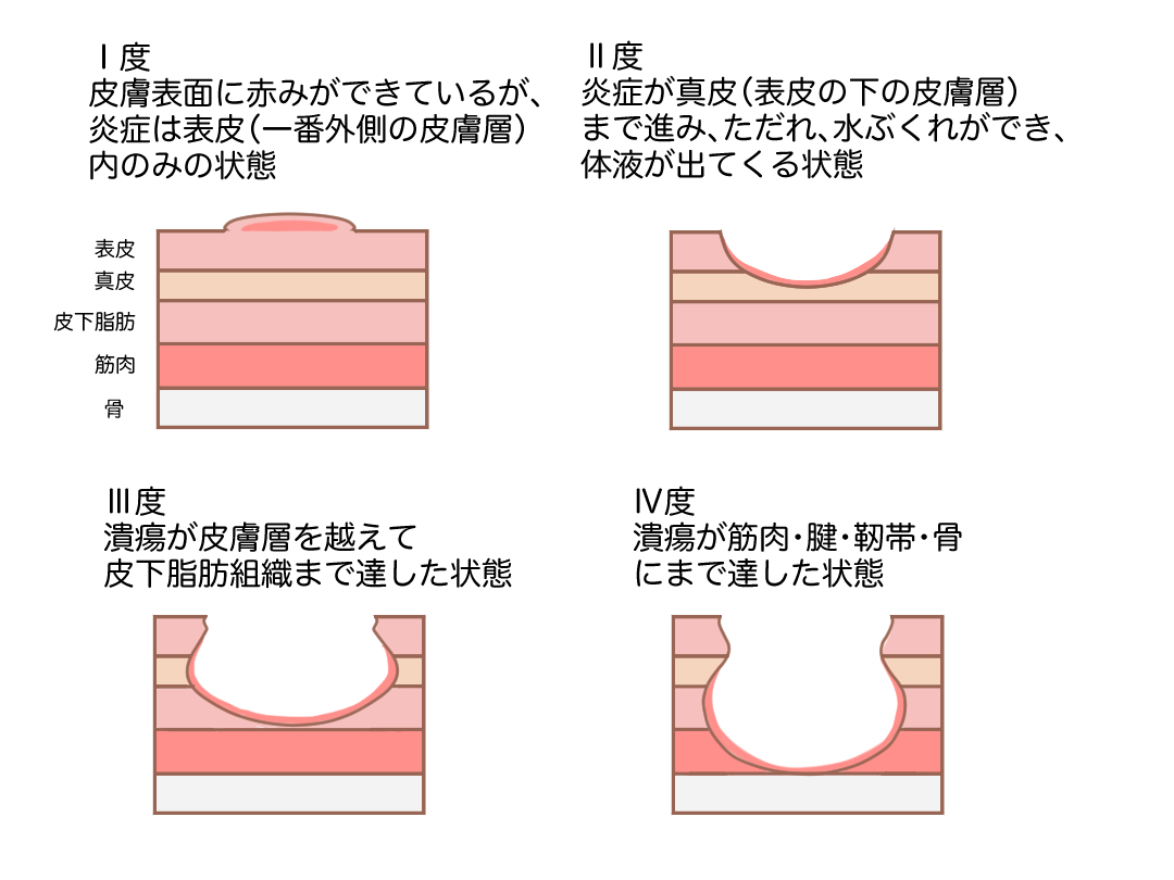 褥瘡重症度